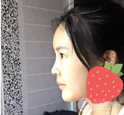 我的自體脂肪面部填充日記