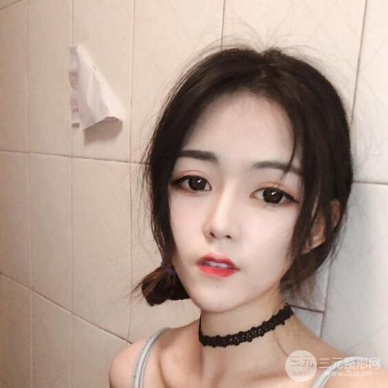 泉州億星醫(yī)療美容閔英俊切開(kāi)雙眼皮果對(duì)比