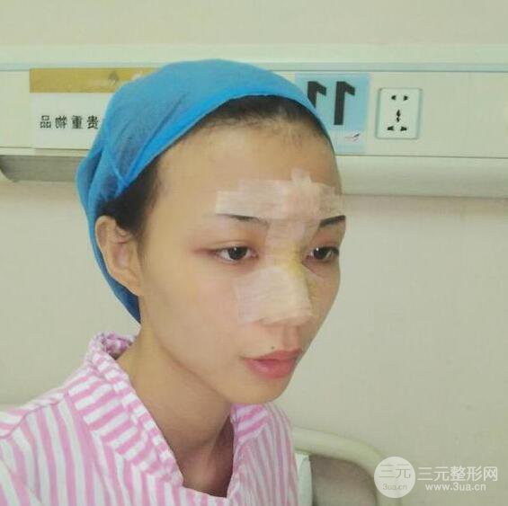 銀川崔大夫博士麗朱杰硅膠隆鼻恢復(fù)圖，輕松get精致臉