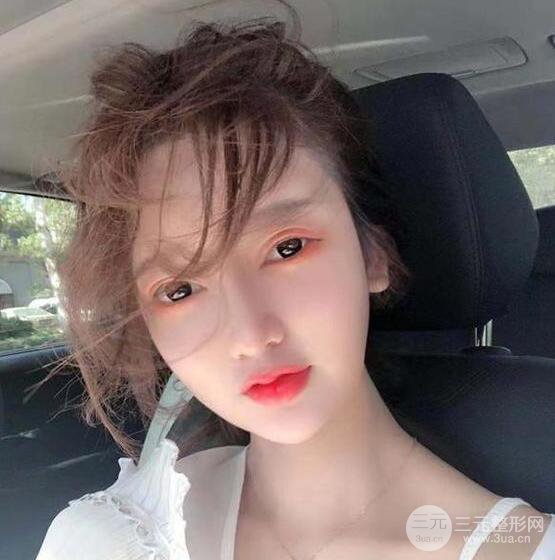 只是做了隆鼻整形改變居然辣么大，快來看看我的隆鼻整形恢復(fù)日記叭