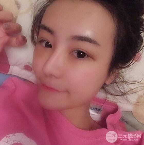 做了自體脂肪填充全臉，別人都以為我老公較為有錢