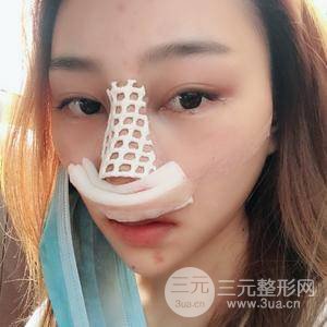 膨體大綜合隆鼻手術恢復過程圖附對比照