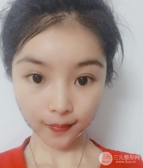 埋埋蛋白線.提升恢復圖，原來小V臉不一定要磨骨