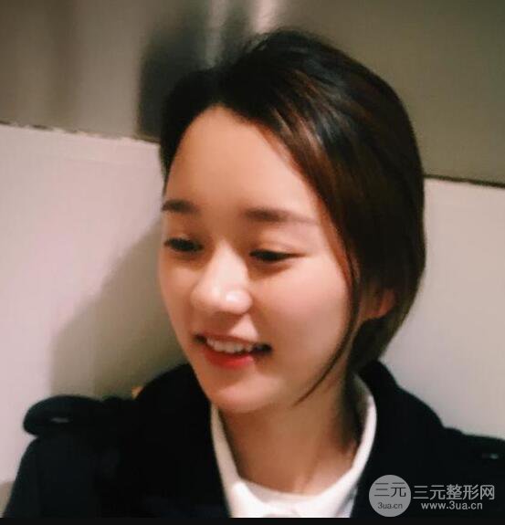 自體脂肪全臉填充三個月恢復圖，真實案例分享