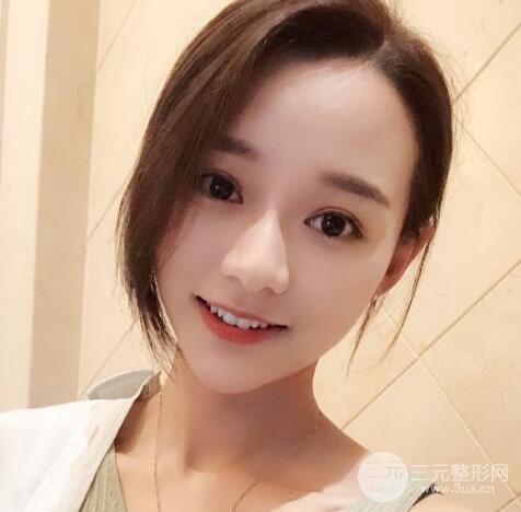 自體脂肪全臉填充三個月恢復圖，真實案例分享