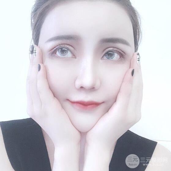 原來(lái)我和baby的距離只差一個(gè)網(wǎng)紅套餐，“雙眼皮+自體脂肪填充+豐唇”術(shù)后真人反饋