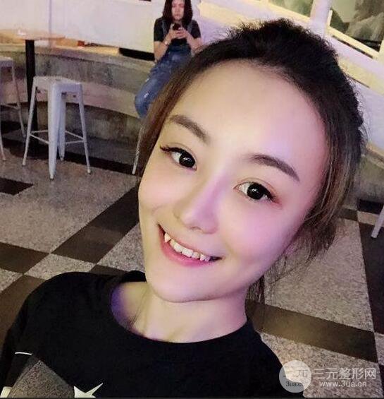 做了自體脂肪填充全臉，別人都以為我老公較為有錢