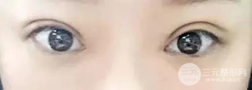 雙眼皮手術(shù)后恢復(fù)期記錄