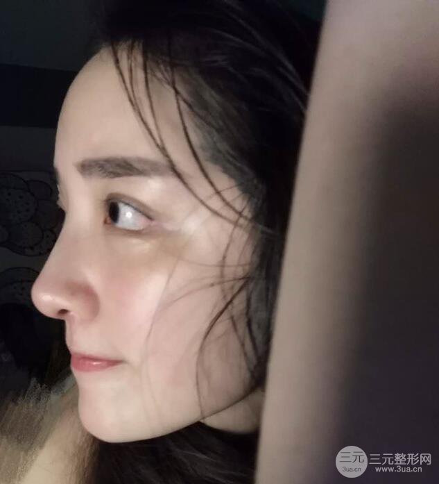 東莞寶格麗韋文奇隆鼻整形果圖分享，對比曝光