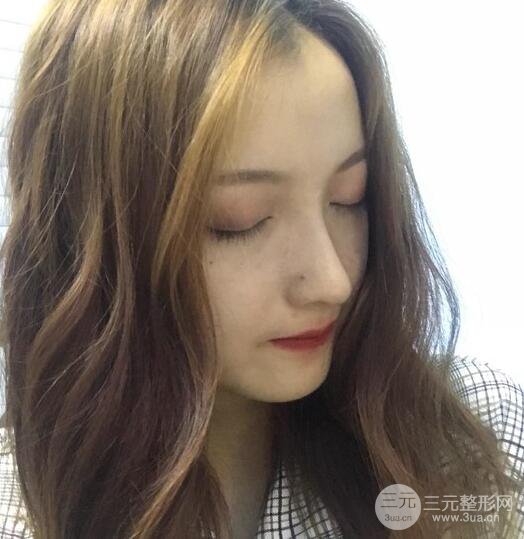 隆鼻整形多久恢復(fù)自然，模特公布隆鼻整形恢復(fù)記錄附照片