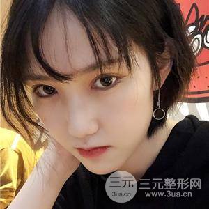 雙眼皮三個月果恢復(fù)圖