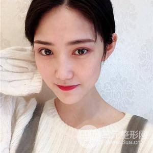 雙眼皮三個月果恢復(fù)圖