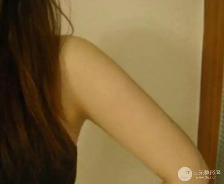 抽手臂脂肪的恢復(fù)過(guò)程