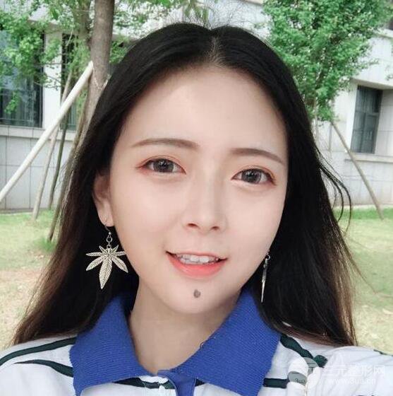 揚(yáng)州艾菲斯黃嬋雙眼皮多項(xiàng)整形整形果真人反饋