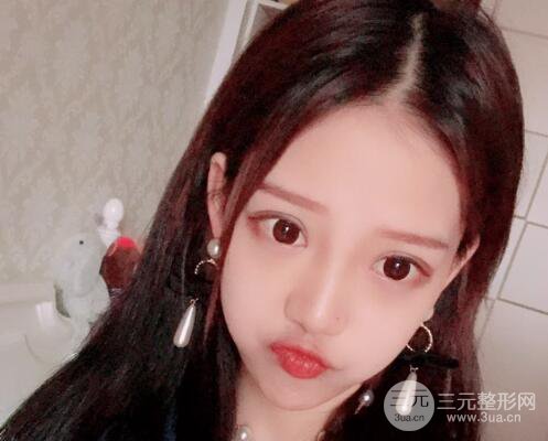 割雙眼皮多久會恢復