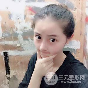 網(wǎng)紅鼻整形三十天恢復記錄