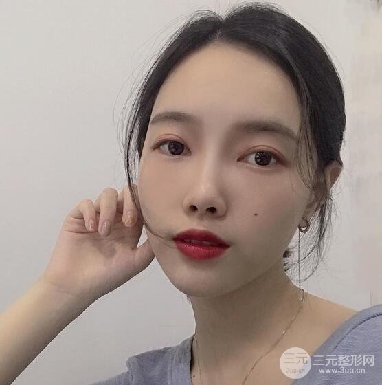 上海華美李健自體脂肪詳細(xì)部填充果圖，少女臉經(jīng)久不衰的秘密在這里