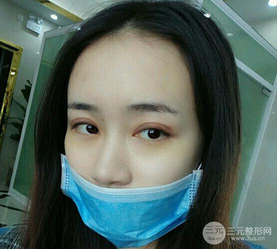 雙眼皮7mm一年后照片