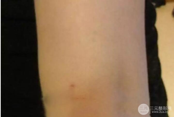 抽手臂脂肪的恢復(fù)過(guò)程