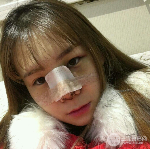 隆鼻整形三個(gè)月恢復(fù)真實(shí)圖片，做完土妹子變網(wǎng)紅辣