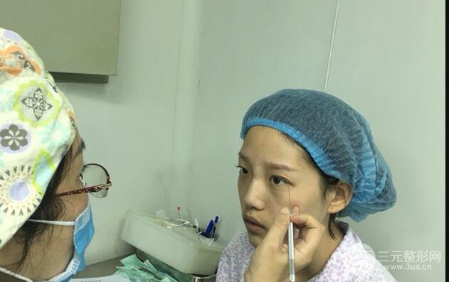 割雙眼皮多久會恢復