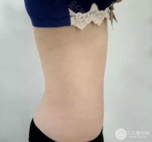 腹腰吸脂三個月圖片