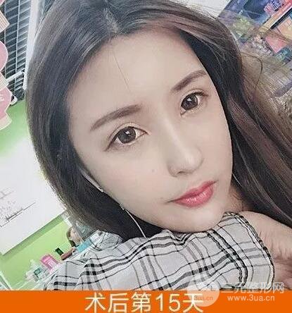 我的自體脂肪臉部填充日記