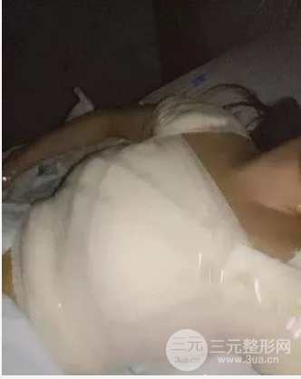 假體隆胸恢復(fù)期3個(gè)月圖片，真人日記曝光