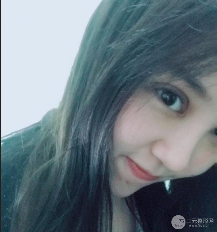 蘇州芘麗芙華美孫培靈全切雙眼皮真人恢復(fù)圖曝光