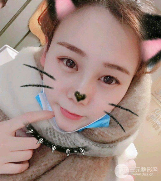 隆鼻整形三個(gè)月恢復(fù)真實(shí)圖片，做完土妹子變網(wǎng)紅辣