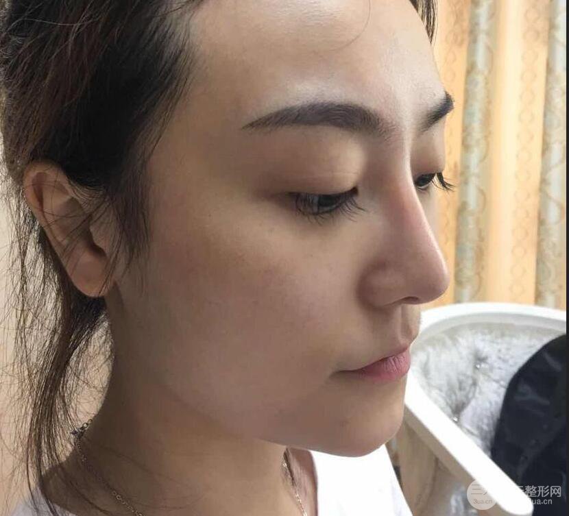 做了自體脂肪填充全臉，別人都以為我老公較為有錢