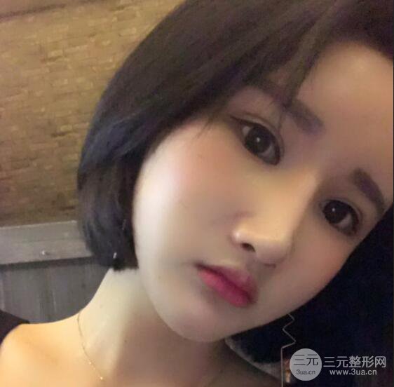 去下頜角+顴骨內(nèi)推手術(shù)三個月記錄，看大臉妹如何逆襲