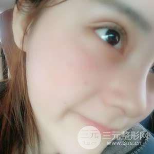 網(wǎng)紅鼻整形三十天恢復記錄