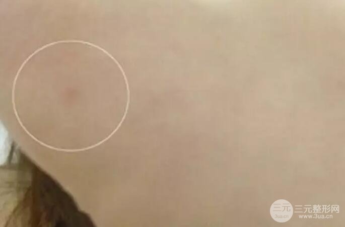 抽手臂脂肪的恢復(fù)過(guò)程