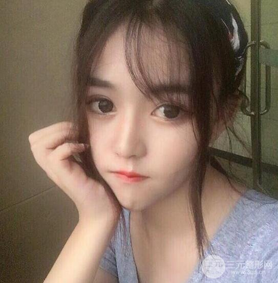 泉州億星醫(yī)療美容閔英俊切開(kāi)雙眼皮果對(duì)比