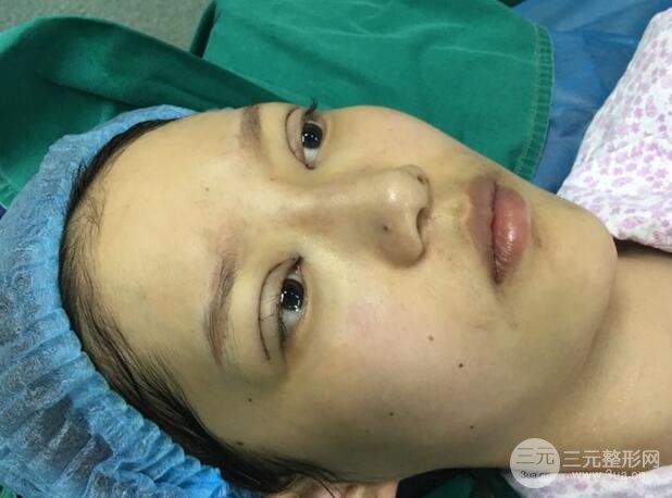 割雙眼皮多久會恢復