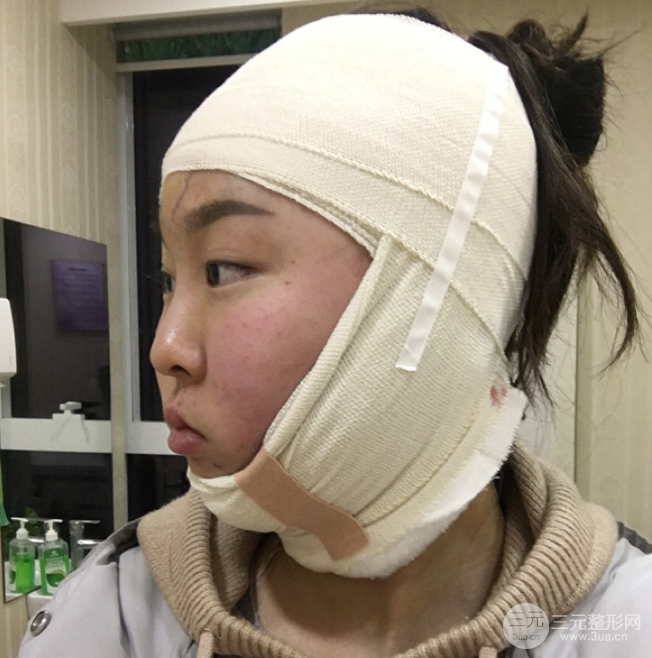 面部光纖溶脂三個(gè)月恢復(fù)記錄，妹子終于擺脫大臉盤子辣