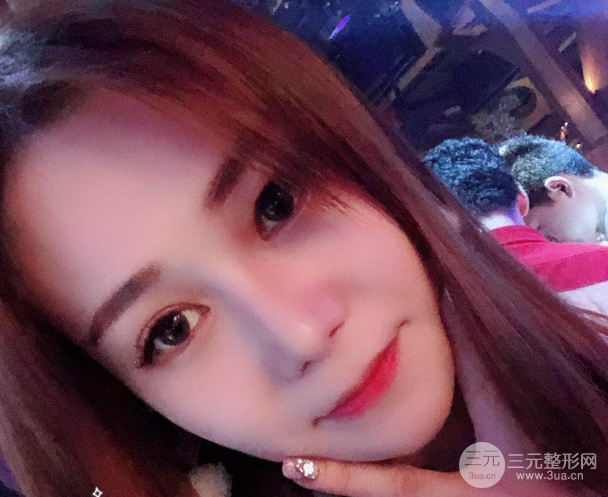 隆鼻整形三個(gè)月恢復(fù)真實(shí)圖片，做完土妹子變網(wǎng)紅辣