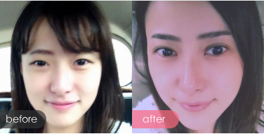 雙眼皮多少錢?雙眼皮整形手術(shù)前后對比圖