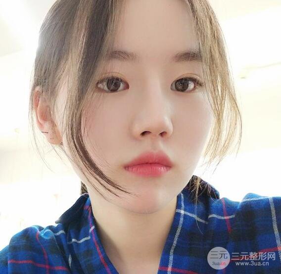 上海華美醫(yī)療美容李庭勛膨體隆鼻怎么樣？果對比圖