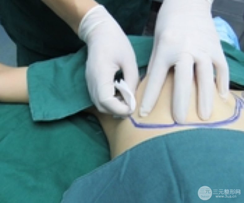 自體脂肪隆胸恢復(fù)圖曝光，見證從A到C的蛻變