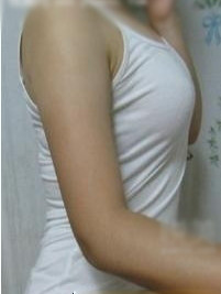 大家看看我在北京麗都陳萬芳醫(yī)生做的手臂吸脂怎么樣