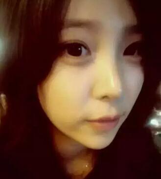 我的假體隆鼻恢復(fù)過(guò)程,有圖有真相哦~