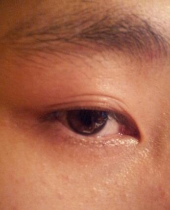 八大處靳小雷埋線雙眼皮一個(gè)多月了，果很好哦~~~