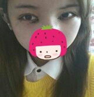 一起來評價一下重慶愛思特盧剛醫(yī)生做的切開雙眼皮吧