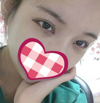 一起來評價一下重慶愛思特盧剛醫(yī)生做的切開雙眼皮吧