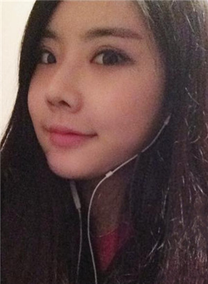 重慶愛思特鄭東學(xué)做的駝峰鼻矯正變美了