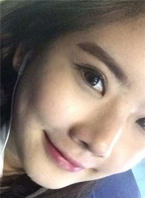 重慶愛思特鄭東學(xué)做的駝峰鼻矯正變美了