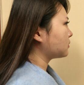 董薇薇醫(yī)師為我做的玻尿酸墊下巴術(shù)前術(shù)后對(duì)比照