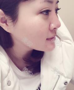 董薇薇醫(yī)師為我做的玻尿酸墊下巴術(shù)前術(shù)后對(duì)比照